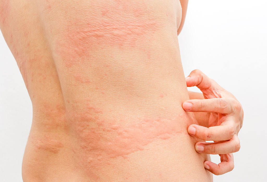 Postpartum Hives: Another Name For Pregnancy Rash